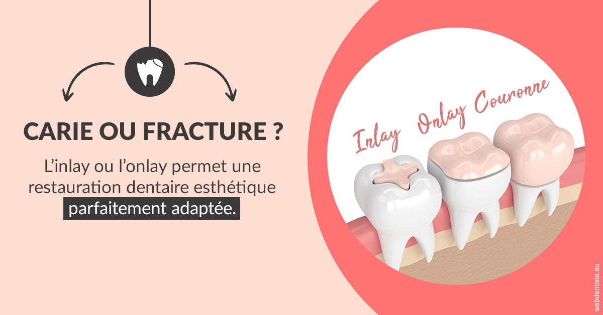 https://dr-aubry-marie-pierre.chirurgiens-dentistes.fr/T2 2023 - Carie ou fracture 2