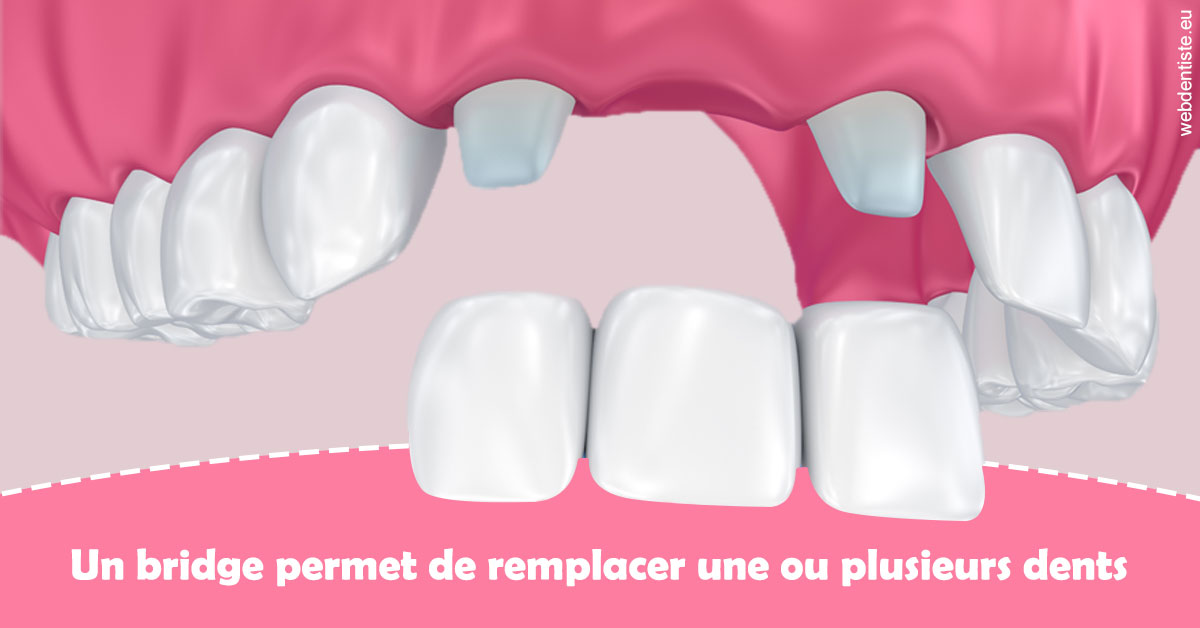 https://dr-aubry-marie-pierre.chirurgiens-dentistes.fr/Bridge remplacer dents 2