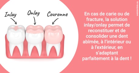 https://dr-aubry-marie-pierre.chirurgiens-dentistes.fr/L'INLAY ou l'ONLAY 2