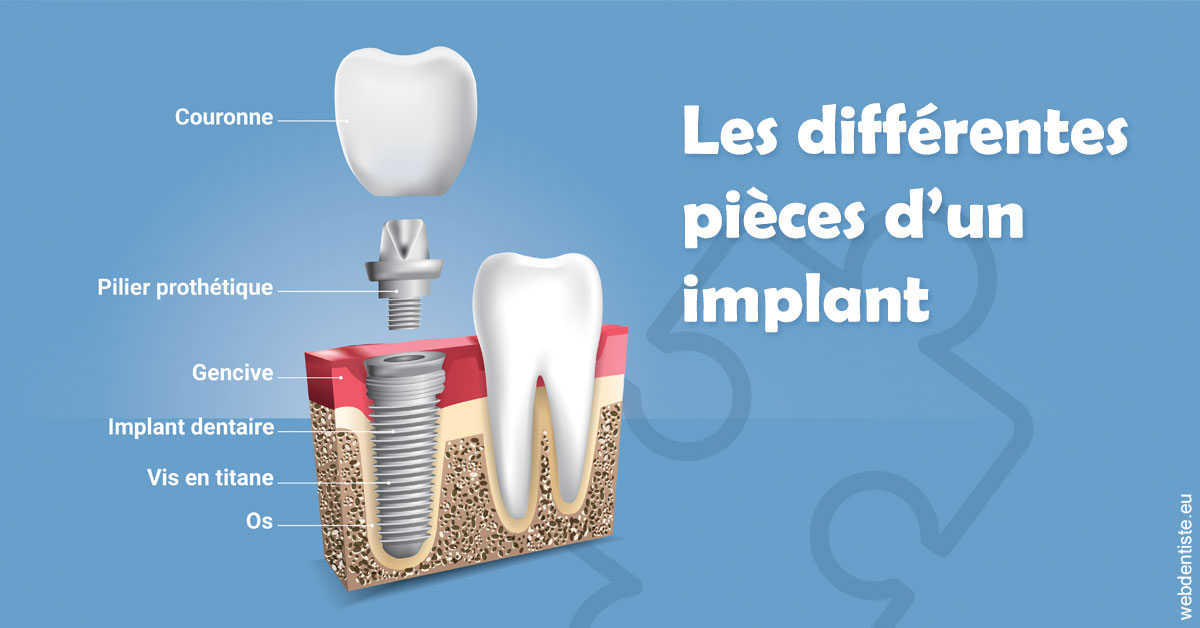 https://dr-aubry-marie-pierre.chirurgiens-dentistes.fr/Les différentes pièces d’un implant 1